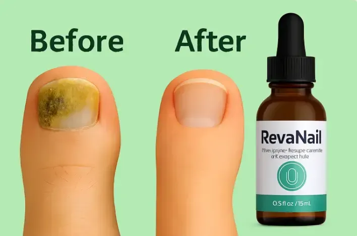 RevaNail™ – Natural Antifungal Serum